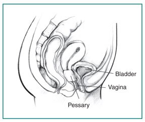 A pessary inserted into the vagina to support the bladder.