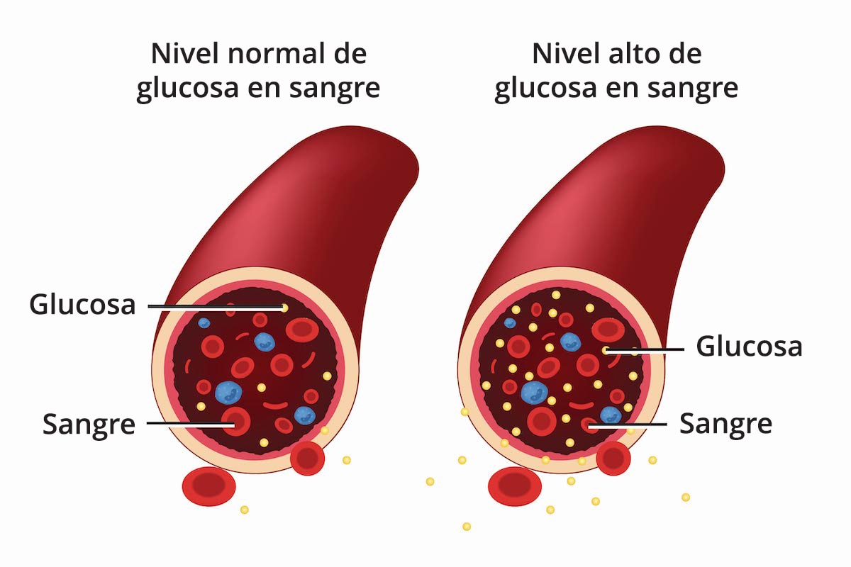A la izquierda, un diagrama de un vaso sanguíneo que tiene un nivel normal de glucosa en sangre y contiene menos moléculas de glucosa. A la derecha, un diagrama de un vaso sanguíneo que tiene un nivel alto de glucosa en sangre y contiene más moléculas de glucosa. 