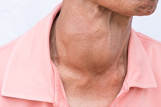 A woman’s neck with a goiter.