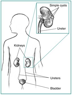 The urinary tract of a male figure, with an inset image showing a simple kidney cyst.