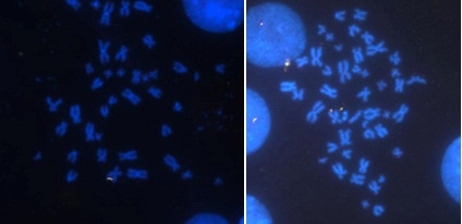 Photo of Chromosome fragility in FXS cells.