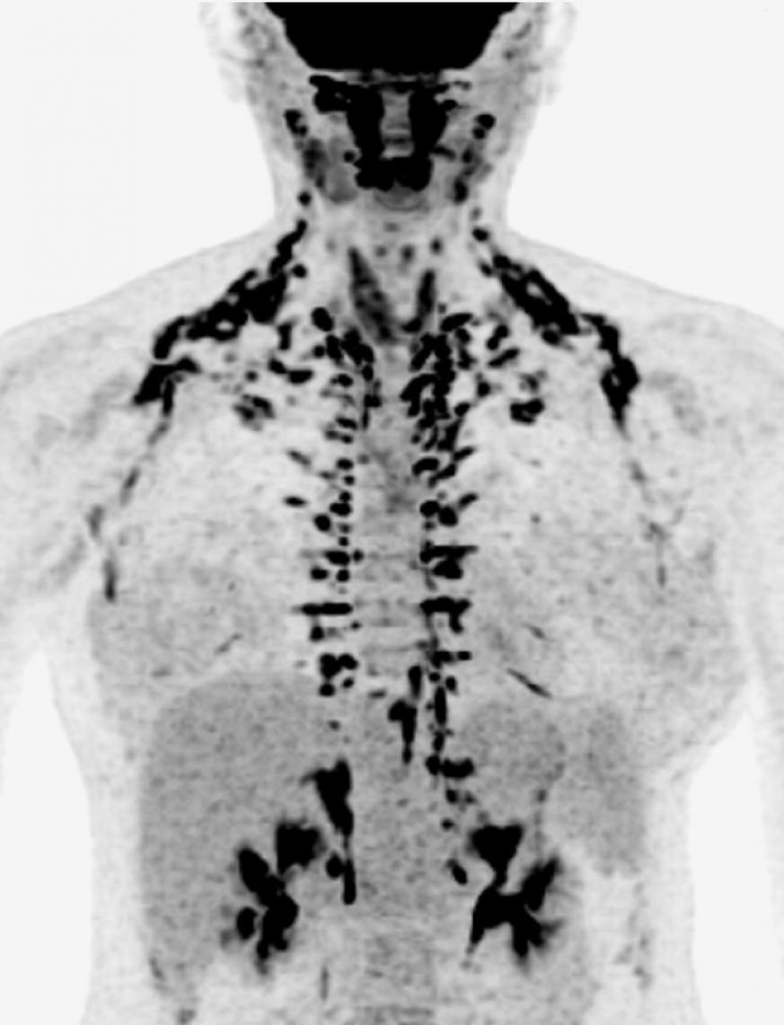 Image highlighting human brown adipose tissue, or brown fat