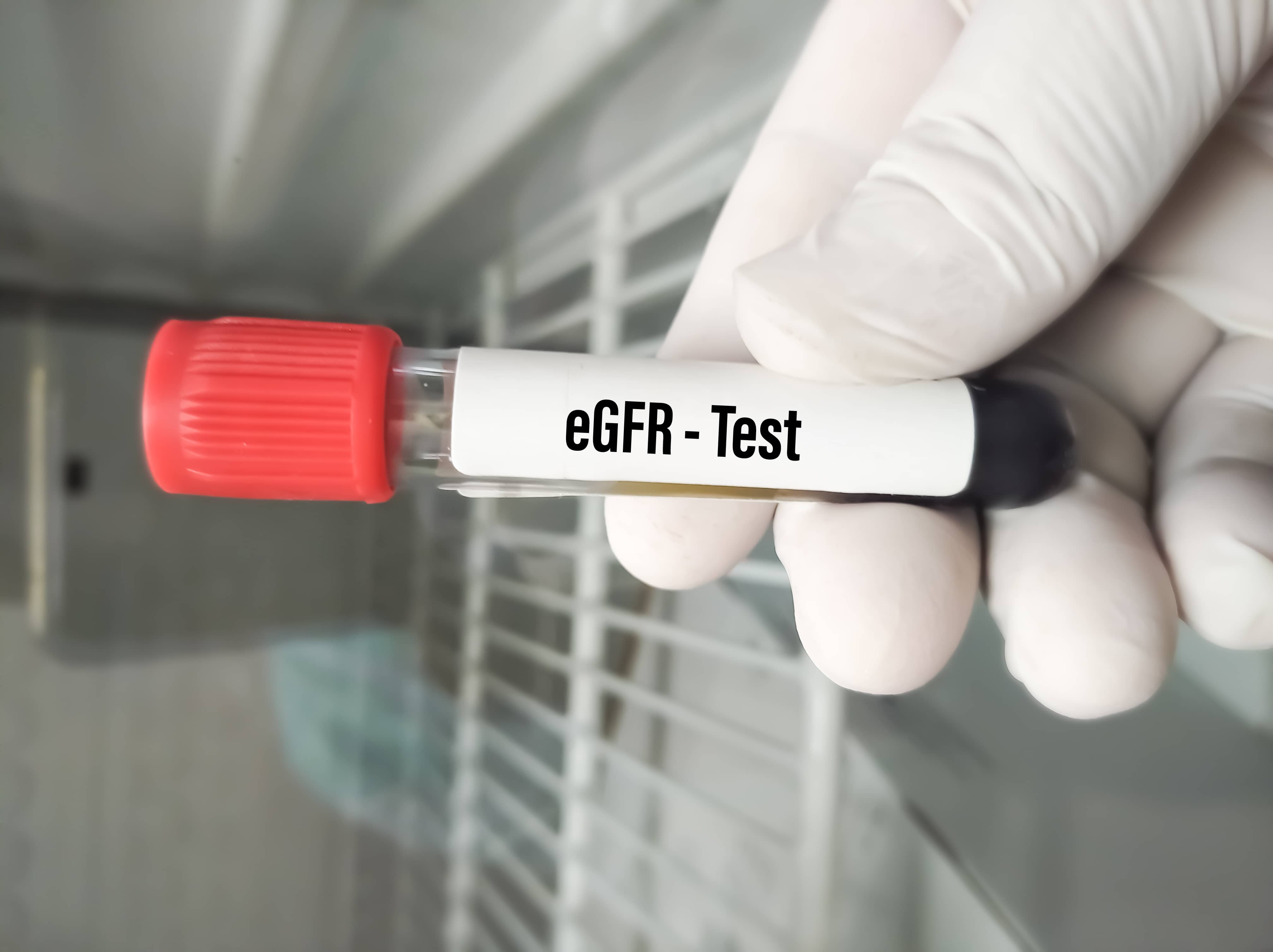 A photo of a blood sample vial ready for estimated glomerular filtration rate, or eGFR, testing.