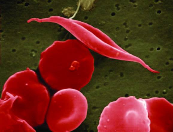 Sickle cell disease (SCD)