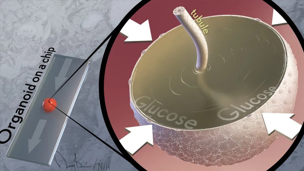 A formation of a cyst within kidney organoid on a chip. As cyst absorbs glucose passing through the tubule, it grows larger.