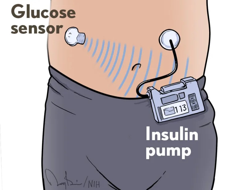 A young child wearing an insulin pump at the waist with a glucose sensor affixed on the abdomen. The glucose sensor sends a signal to an insulin pump, and a tube runs to another adhesive on the abdomen to deliver insulin.