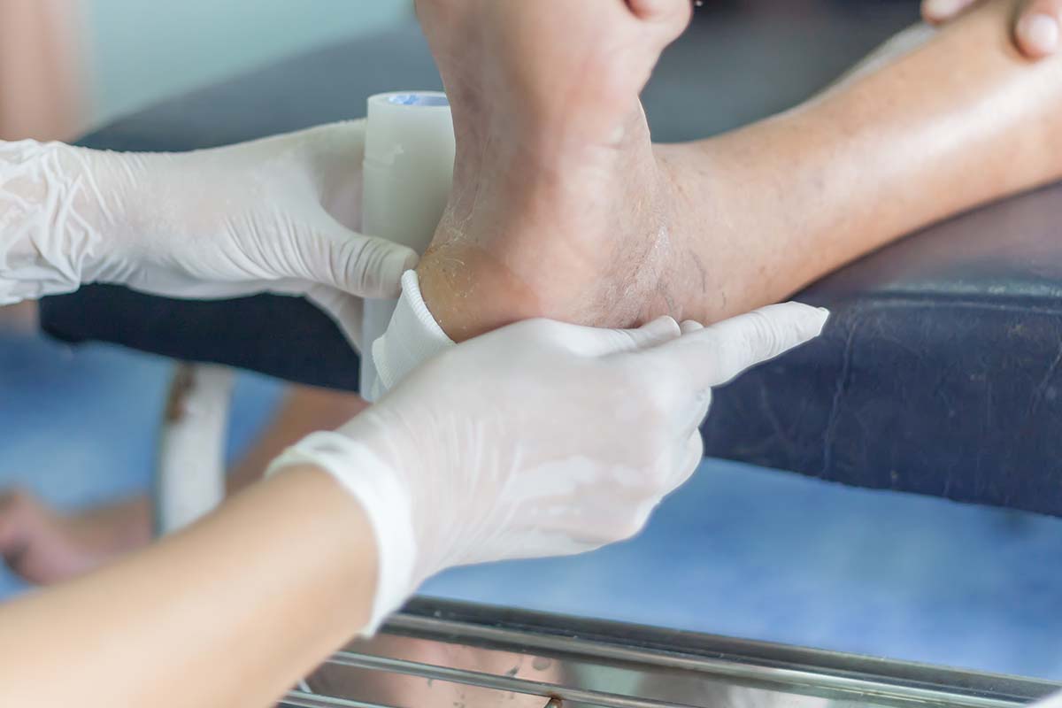 Clinician wrapping a foot ulcer on the heel of a patient