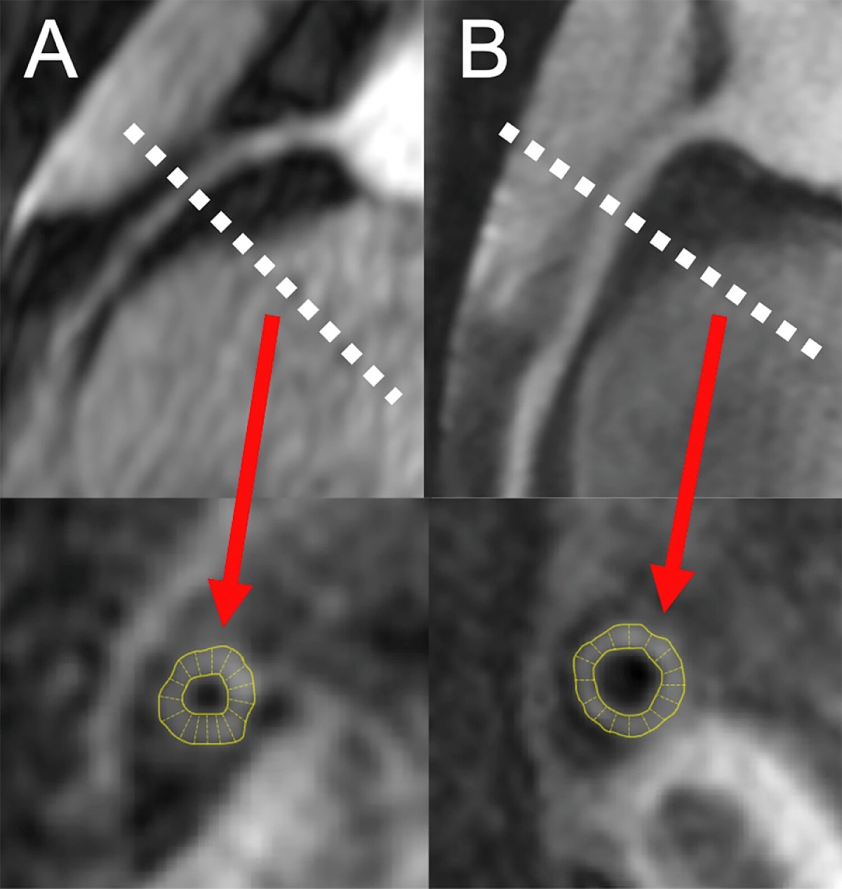 Magnetic resonance angiograms of right coronary arteries in two people living with HIV comparing coronary wall thickness.