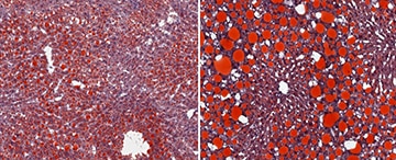 Dual image, left shows steatosis (fat build-up, red) in the liver of a normal mouse fed a high-fat diet, the right shows markedly higher steatosis in the liver of a mouse lacking IFN-gamma fed a high-fat diet.