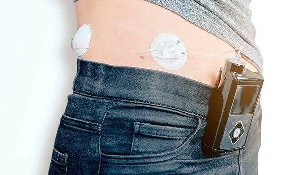 An artificial insulin delivery system