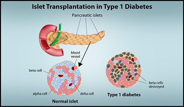 Faded blue background with title, â€œIslet Transplantation in Type 1 Diabetesâ€. Image of Pancreas with pancreatic islets emphasized and an arrow pointing to a normal islet microscopic image on the left side. The normal islet features the beta, alpha and delta cells as well as the blood vessels in blue, light red, purple and dark red colors, respectively. Next to this image is another microscopic image of type 1 diabetes in an islet cell. This image shows the beta cells destroyed in a gray color.