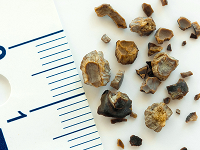 Kidney stones next to a ruler.
