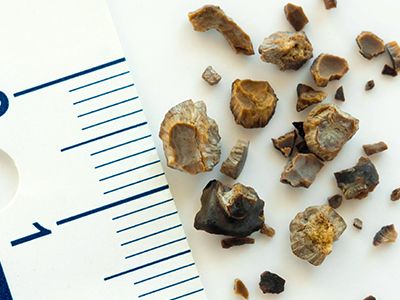 Various sizes of kidney stones laying next to a ruler.