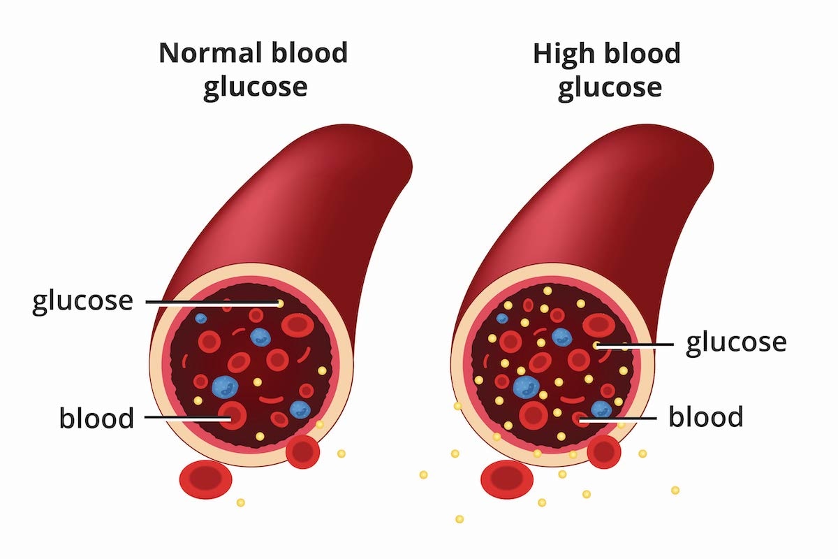 On the left, a diagram of a blood vessel that has a normal blood glucose level and contains fewer glucose molecules. On the right, a diagram of a blood vessel that has a high blood glucose level and contains more glucose molecules.