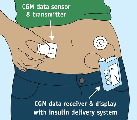 Drawing of a continuous glucose monitor. A transmitter patch on the belly covers a tiny glucose sensor under the skin. The transmitter sends data to a small receiver with a viewing screen, which is clipped to a belt. The CGM receiver shown here is part of an insulin pump.