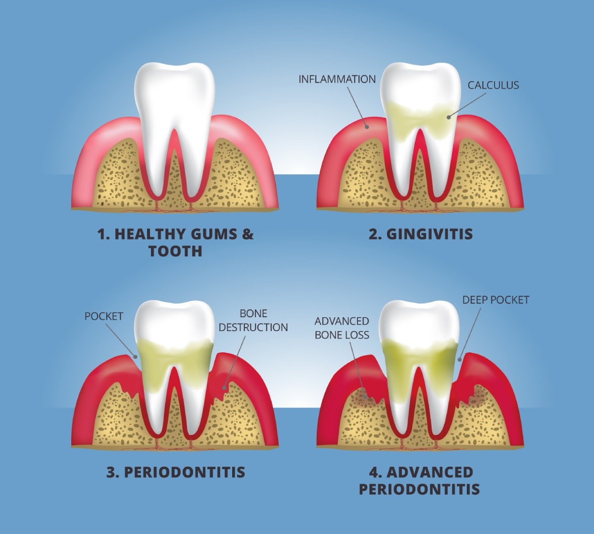 Close-up illustration of tooth and gums, showing four stages of gum disease: (1) healthy gums and tooth, (2) gingivitis, (3) periodontitis, and (4) advanced periodontitis. Labels point out inflammation, calculus, pocket, bone destruction, advanced bone loss, and deep pocket.