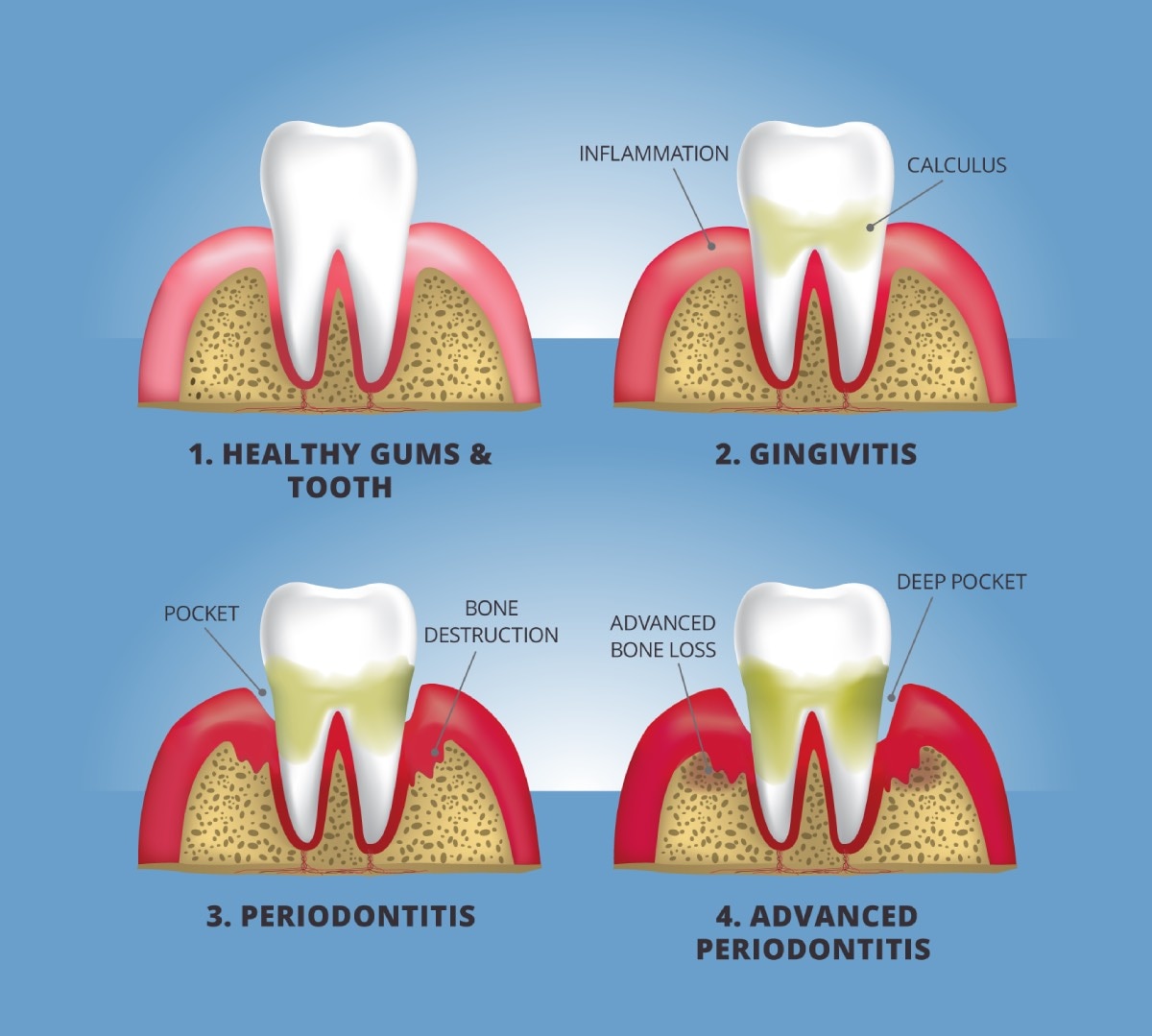 How Gum Disease Impacts Your Health