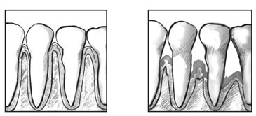 Drawing of a close-up view of teeth and healthy gums, and a drawing of a close-up view of teeth and gums with periodontitis.