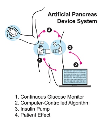 رسم توضيحي لشخص يرتدي جهاز بنكرياس اصطناعي.