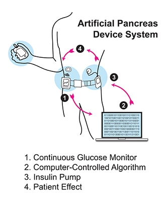 type 1 diabetes treatment options)