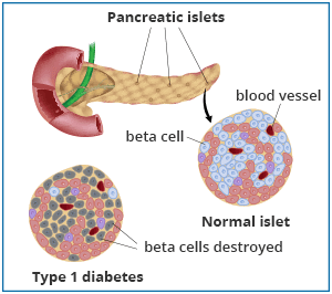 Illustration of the pancreas with insets showing a normal islet, with many healthy beta cells, and an islet from a person with type 1 diabetes, with many destroyed beta cells.