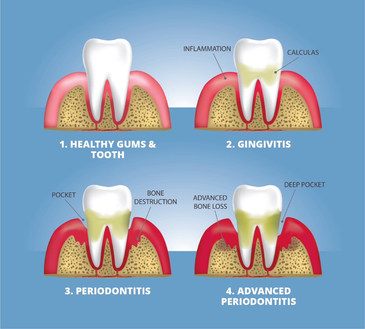 Diabetes Gum Disease Other Dental Problems NIDDK Diabetes Gum Disease Other Dental Problems NIDDK