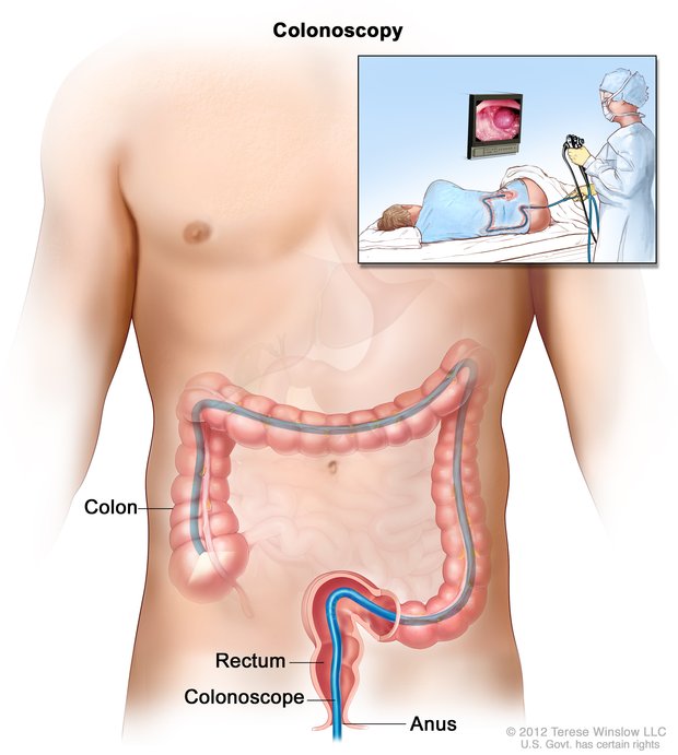 Drawing of a torso and a colonoscope in the anus, rectum, and colon. An inset shows a health professional performing a colonoscopy and a patient on his side.
