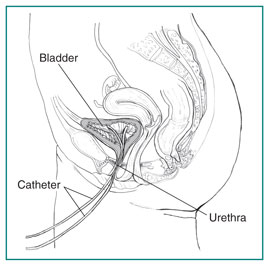 Side view drawing of the female urinary tract with catheters inserted through the urethra to the bladder. The catheters, urethra, and bladder are labeled.