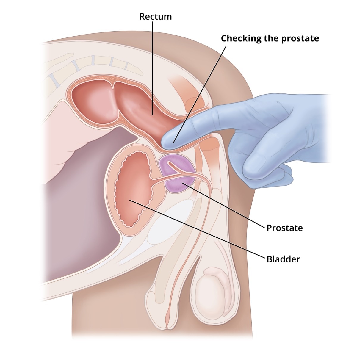 Cross-section illustration of male anatomy shows a gloved index finger inserted into the rectum to check the prostate. Labels show the rectum, prostate, bladder, and the finger checking the prostate.