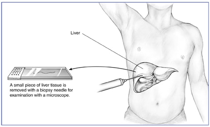 رسم توضيحي لخزعة الكبد عن طريق الجلد ، يُظهر الكبد داخل جذع بشري ، وإبرة يتم إدخالها في البطن ، وشريحة مع عينة من الأنسجة.