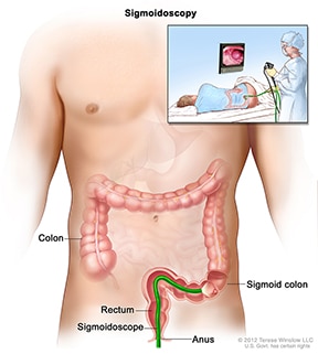 Illustration of Flexible Sigmoidoscopy