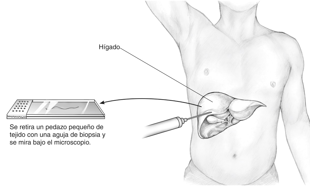 Ilustración de una biopsia del hígado percutánea, que muestra el hígado dentro de un torso humano, una aguja insertada en el abdomen y un portaobjetos.