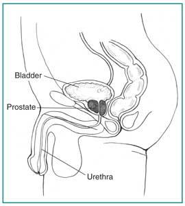 prostate infection urine test