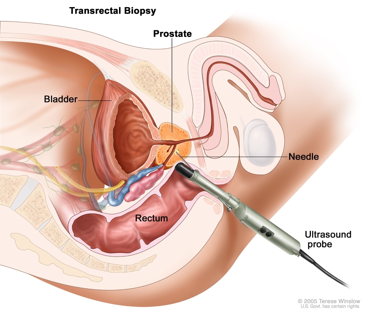 Cross-section of male anatomy shows an ultrasound probe with needle inserted into the rectum taking a tissue sample from the prostate. Labels show the bladder, rectum, prostate, ultrasound probe, and needle.