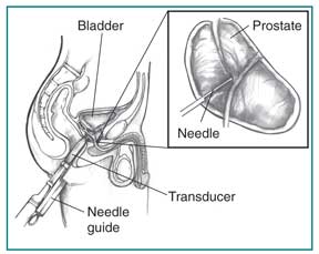 Drawing of a transrectal ultrasound with prostate biopsy, showing a needle and needle guide inserted in the rectum. The bladder, transducer, and needle guide are labeled. Inset of enlarged view of prostate with needle inserted. The prostate and needle are labeled.