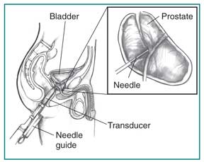 urine test for prostate problems