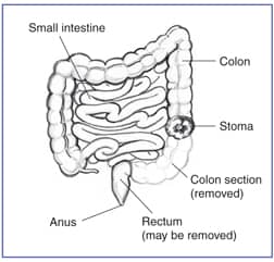 Drawing of the small intestine, colon, stoma of the colon, rectum, and anus. Drawing outlines the removed section of the colon.