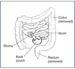 Drawing of the ileum, Kock pouch, and stoma. Drawing outlines the removed colon and removed rectum.