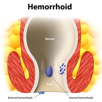 Drawing showing internal and external hemorrhoids in the rectum and anus.