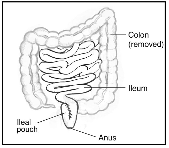 Drawing of the removed colon, and the ileum, ileal pouch, and anus.