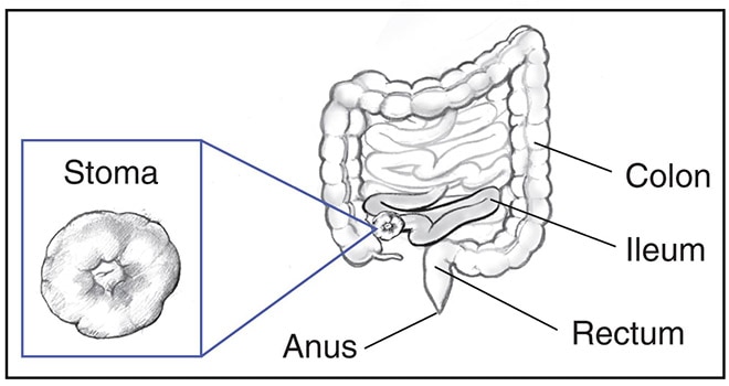 Drawing of the colon, ileum, stoma of the ileum, rectum, and anus. Inset shows a detailed drawing of the stoma.