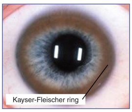 Farbfoto eines menschlichen Auges mit Kayser-Fleischer-Ringen.