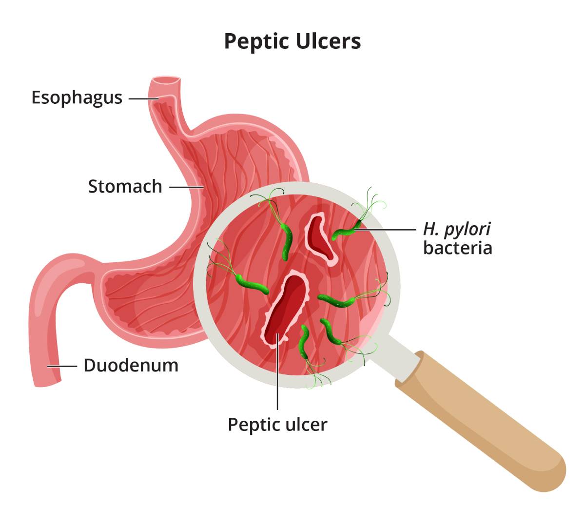 A close-up of peptic ulcers, showing damage to the stomach lining caused by H. pylori bacteria.