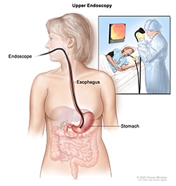 Illustration of an upper GI endoscopy procedure