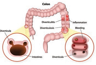 Diverticulosis and Diverticulitis