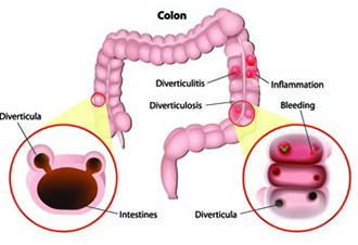 Illustration of the colon of a person with diverticulosis and diverticulitis. Includes labels for diverticulosis, diverticulitis, diverticula, inflammation, bleeding, colon, and intestines.