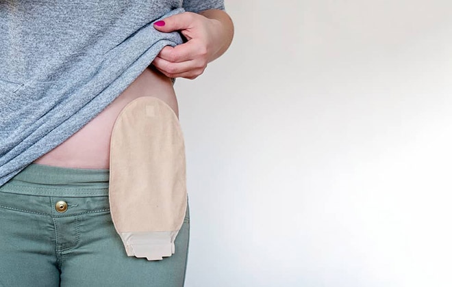 How to Change Your Ostomy Pouch - United Ostomy Associations of