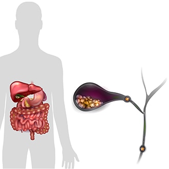 Ilustración de una silueta humana con una vesícula biliar y sus órganos circundantes. Un recuadro muestra la vesícula biliar con cálculos biliares en su interior y los cálculos biliares obstruyendo los conductos biliares.