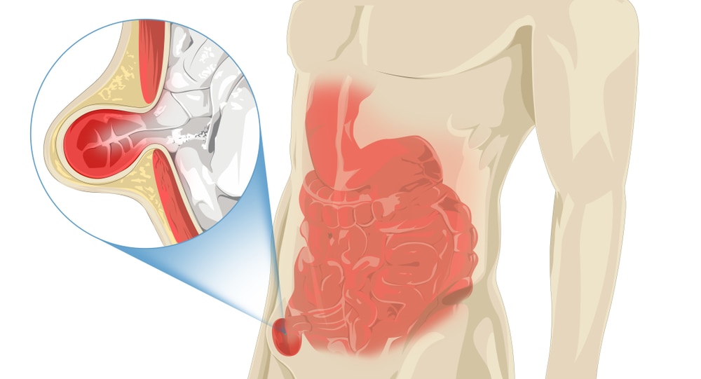 A human torso, with an inset image showing an inguinal hernia.