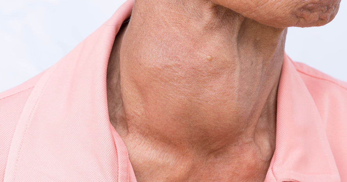 Hashimoto s Disease NIDDK